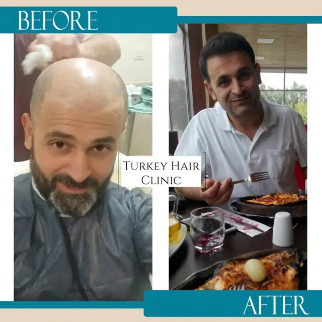 Hair transplant before and after collage — Turkey Hair Clinic, result 1