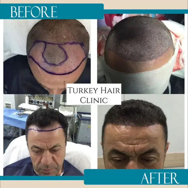 Hair transplant before and after collage — Turkey Hair Clinic, result 6