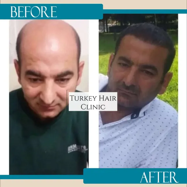 Hair transplant before and after collage — Turkey Hair Clinic, result 9