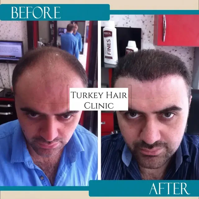 Hair transplant before and after collage — Turkey Hair Clinic, result 18
