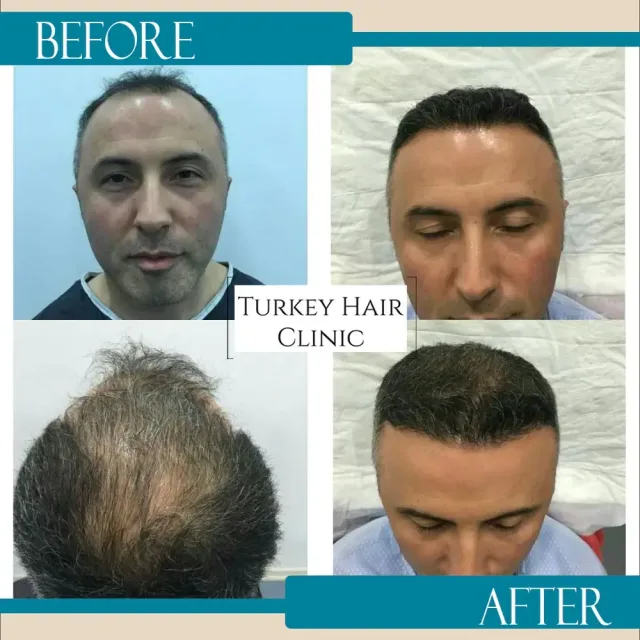 Hair transplant before and after collage — Turkey Hair Clinic, result 20