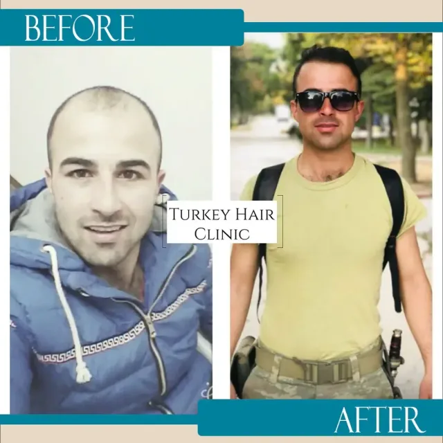 Hair transplant before and after collage — Turkey Hair Clinic, result 29