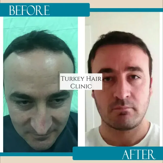 Hair transplant before and after collage — Turkey Hair Clinic, result 39