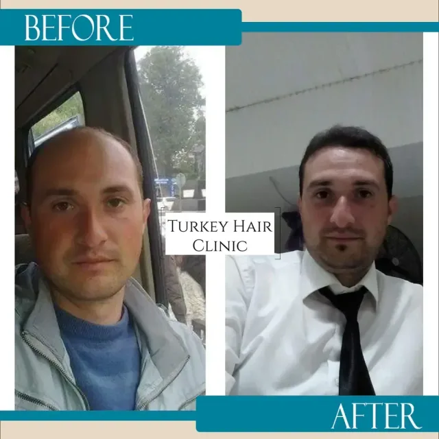 Hair transplant before and after collage — Turkey Hair Clinic, result 42