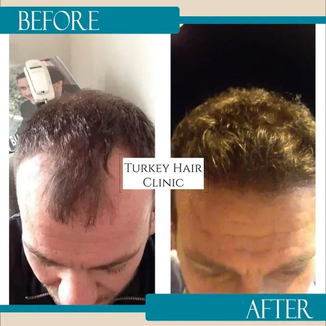 Hair transplant before and after collage — Turkey Hair Clinic, result 43