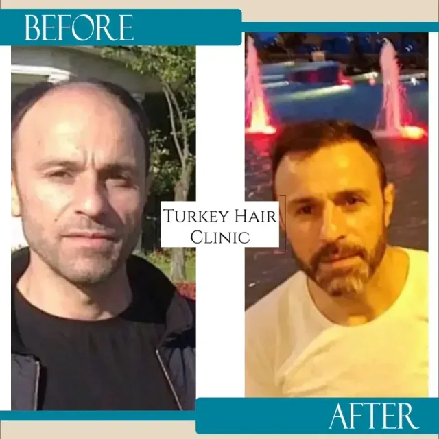 Hair transplant before and after collage — Turkey Hair Clinic, result 51