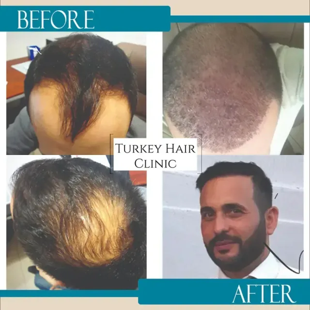 Hair transplant before and after collage — Turkey Hair Clinic, result 53