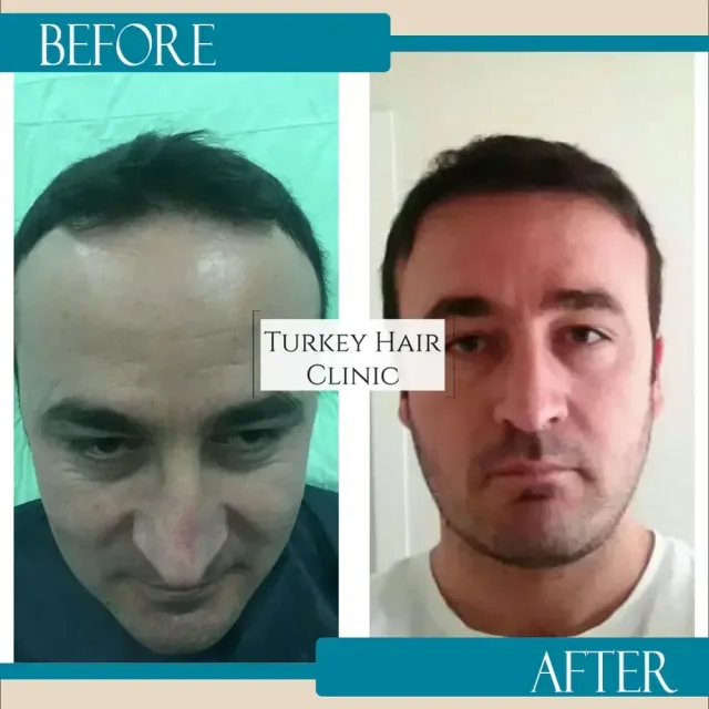 Hair transplant before and after collage — Turkey Hair Clinic, result 55