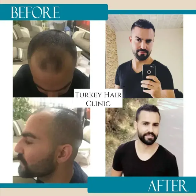 Hair transplant before and after collage — Turkey Hair Clinic, result 63