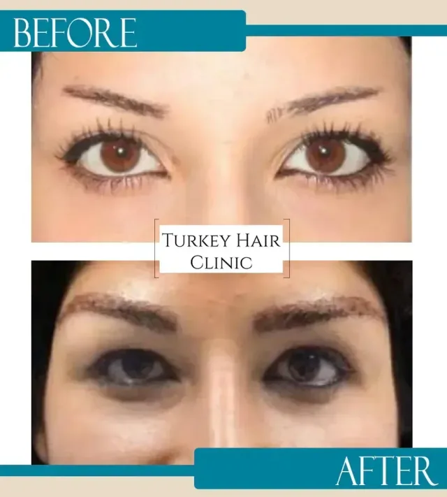 Hair transplant before and after collage — Turkey Hair Clinic, result 64