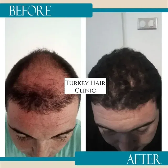 Hair transplant before and after collage — Turkey Hair Clinic, result 72