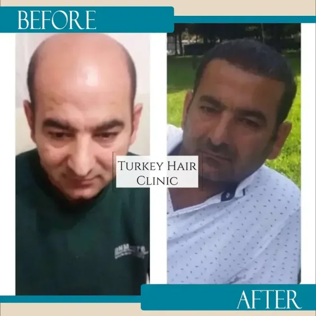 Hair transplant before and after collage — Turkey Hair Clinic, result 73