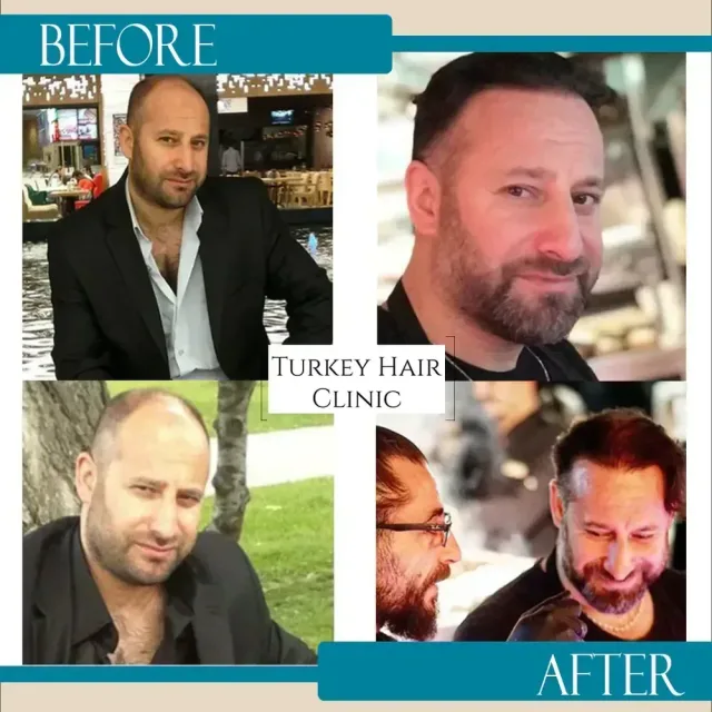 Hair transplant before and after collage — Turkey Hair Clinic, result 76