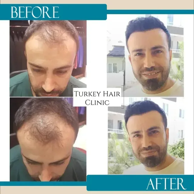 Hair transplant before and after collage — Turkey Hair Clinic, result 78