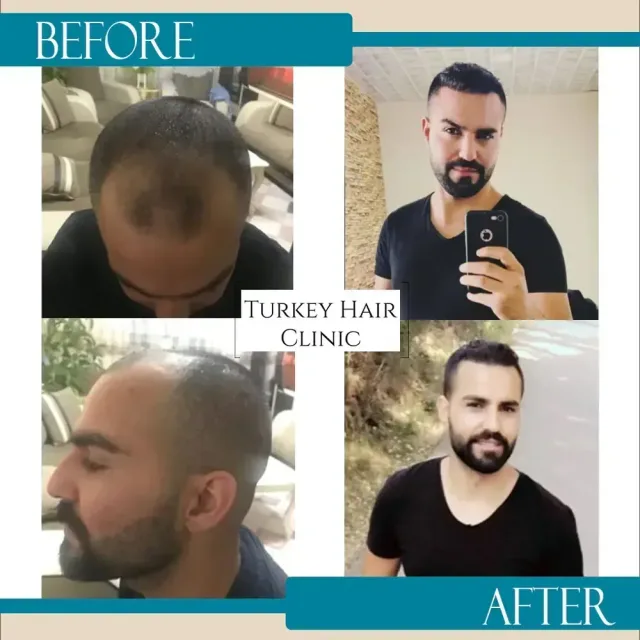Hair transplant before and after collage — Turkey Hair Clinic, result 79